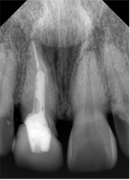 X-ray taken prior to treatment.