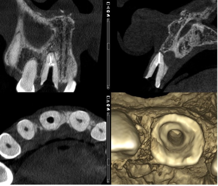 CBCT scan without the restoration.