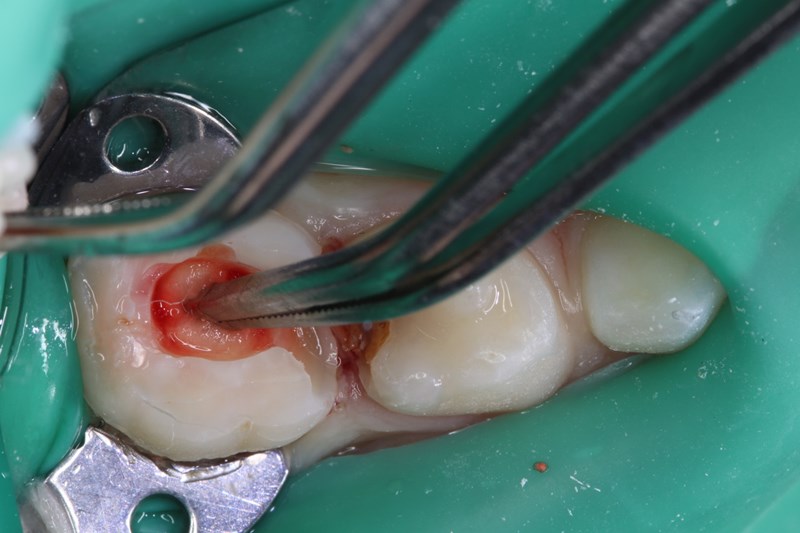 amputation of coronal pulp chamber 1