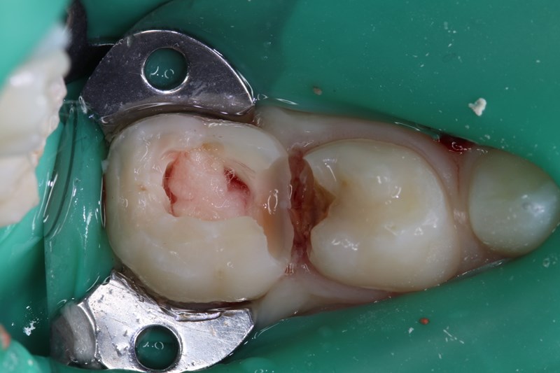 amputation of coronal pulp chamber 2