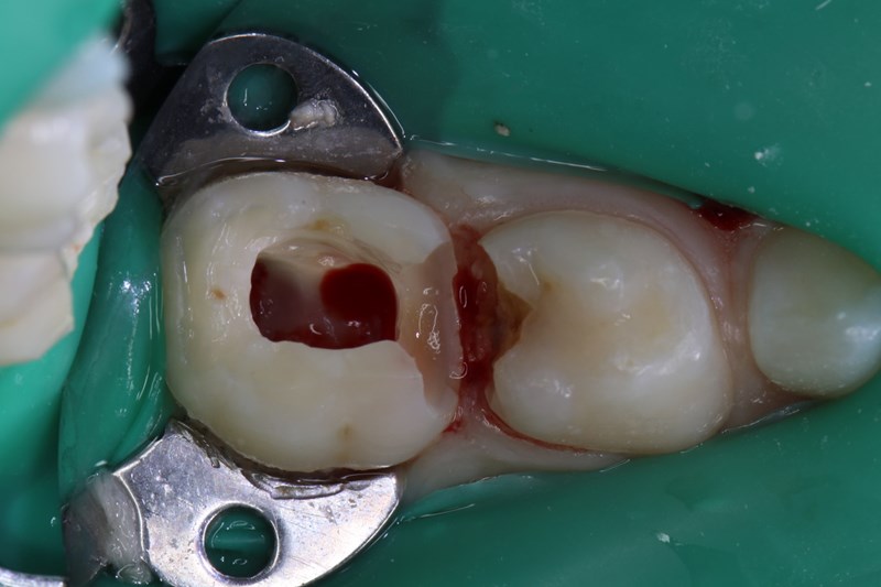 amputation of coronal pulp chamber 3