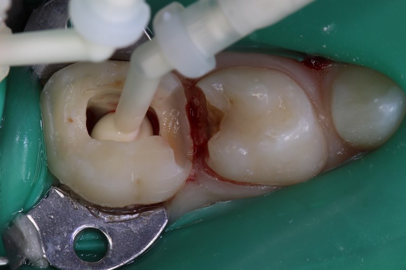 extrusion of theracal pt into the pulp chamber 1