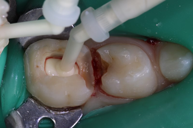 extrusion of theracal pt into the pulp chamber 2